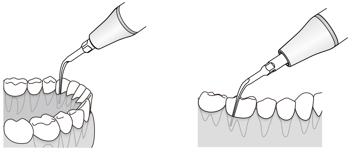 Сфера применения наконечника для скалера